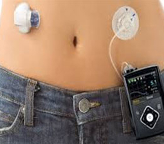 Insulin Pump